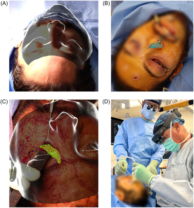Augmented Reality Navigation in Craniomaxillofacial/Head and Neck Surgery.