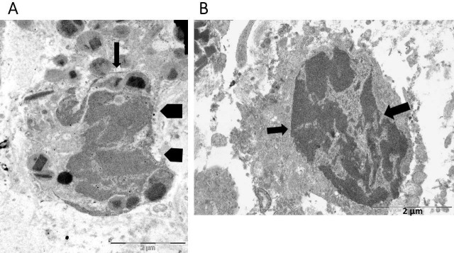 Eosinophil cytolysis with or without ETosis in four cases of human gastric cancer: a comparative ultrastructural study.