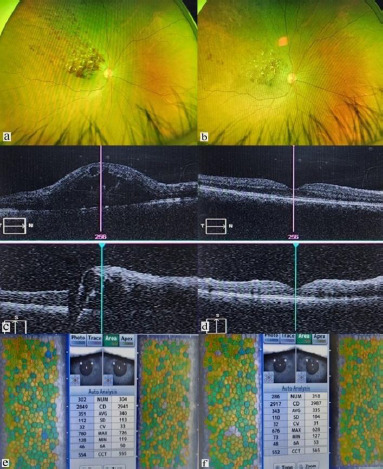Evaluating short-term corneal endothelial alterations post-intravitreal Anti-VEGF injections in treatment naïve eyes.