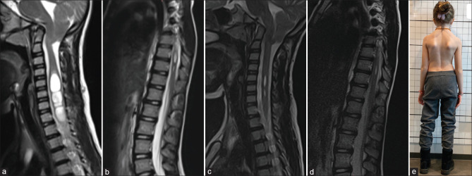 The effect of atlantoaxial stabilization on juvenile idiopathic scoliosis involving Chiari malformation and syrinx.