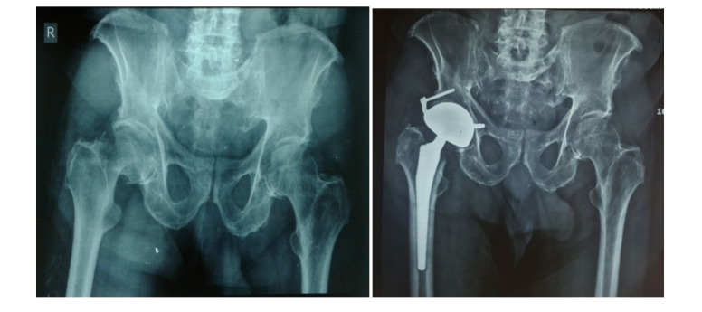Dual Mobility Acetabular Cup Utilization in Total Hip Arthroplasty: Mitigating Instability Risks.