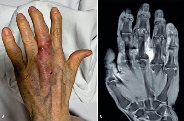 Tenosynovitis caused by Trichosporon asahii in an immunocompetent patient.