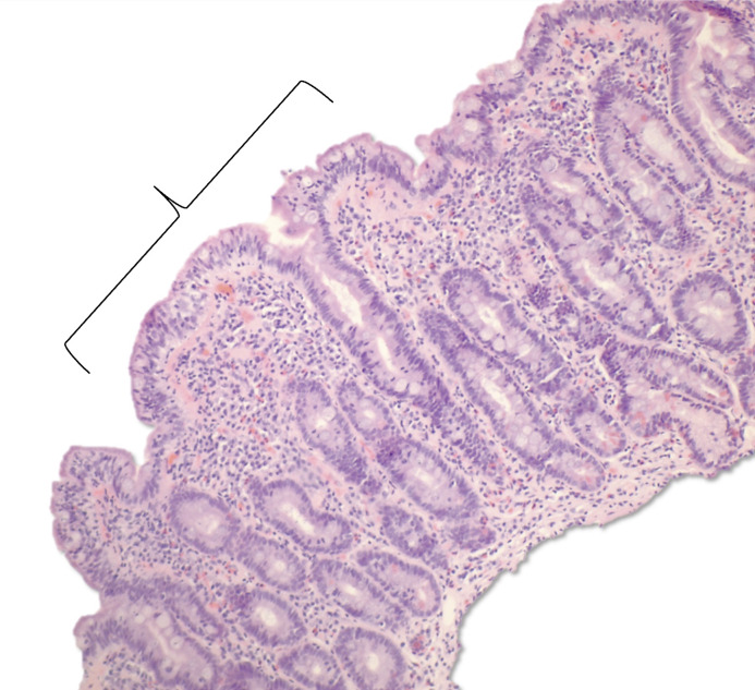 Coexisting Collagenous Sprue and Celiac Disease: A Case Report.