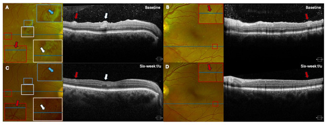 Bilateral acute multifocal retinitis and retinal vasculitis secondary to Rickettsia typhi infection.