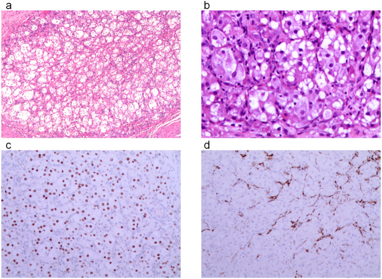 A rare case of Alveolar Soft-Part Sarcoma in the Uterine cervix.