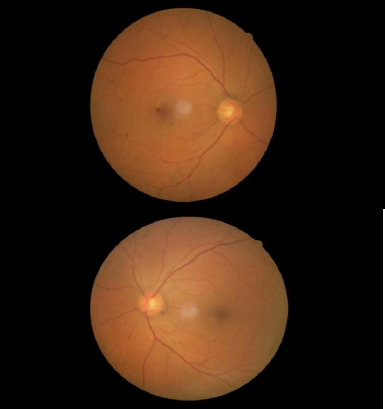 Olfactory Groove Meningioma Compressing the Optic Chiasm and Optic Nerve: Improvement of Visual Functions by Surgical Intervention.