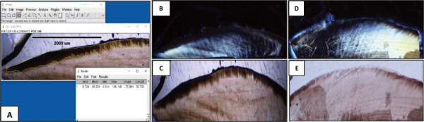 Histological effect of fluoride varnishes on teeth with caries in the white spot phase: An <i>in vitro</i> study.