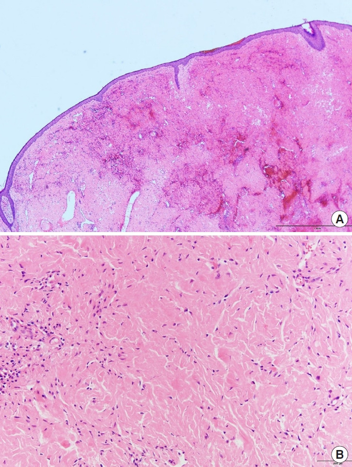Atypical elastofibroma of the philtrum mimicking rosacea: a case report and literature review.