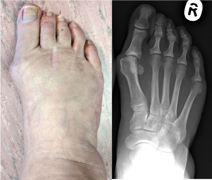 The Inaugural UK National Hallux Valgus Think Tank : identification of key issues and strategies to improve clinical care for patient benefit.