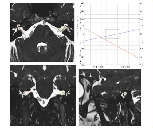 Utility of MRI quantitative analysis in assessment of audio-vestibular impairment.