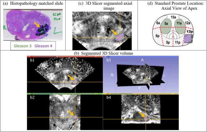 Evaluation of 3D ARFI imaging of prostate cancer: diagnostic reliability and concordance with MpMRI.