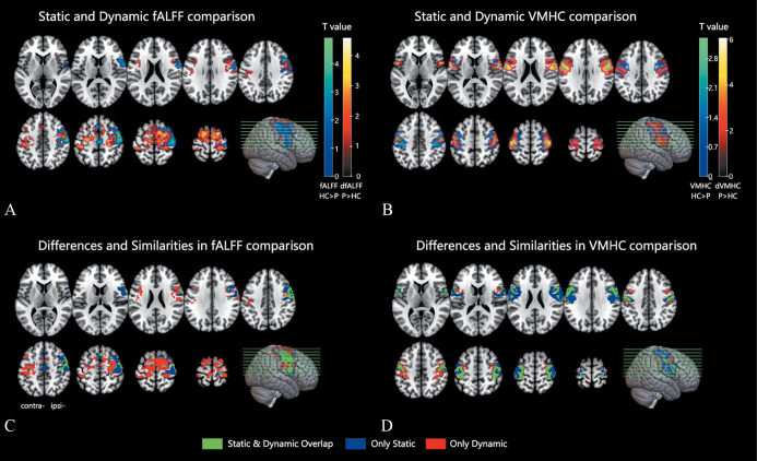 Mirror therapy reduces excessive variability of motor network in stroke patients: a randomized controlled trial.