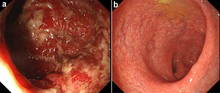 Intensive Granulocyte and Monocyte Adsorptive Apheresis Plus Upadacitinib for Induction Treatment of Refractory Crohn's Disease.
