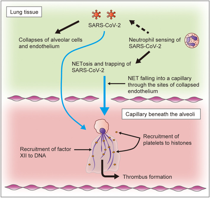Neutrophil Extracellular Traps Capturing SARS-CoV-2 in the Lung Tissue (Alveoli and Parenchyma) Cause Microthrombi　- A Strategy to Eliminate SARS-CoV-2 From the Circulation as Degraded Fibrin Clots.