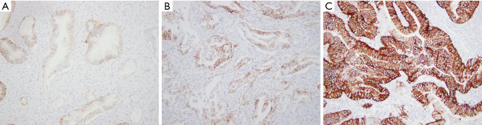 Claudin 18 immunohistochemistry in cholangiocarcinoma.