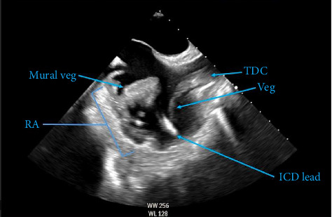 <i>Salmonella</i> Endocarditis: Rare Bacteremia Causing Mural Infective Endocarditis.