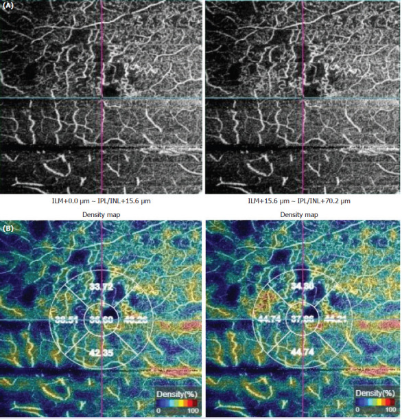 Baseline macular structural and vascular changes as predictive markers of visual improvement in central retinal vein occlusion.