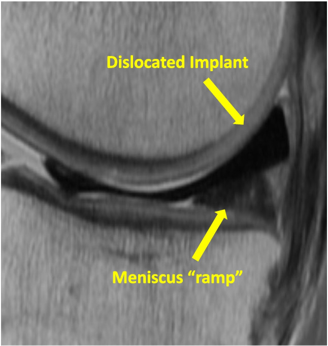 Report on Evolving Indications, Technique, and Outcomes of Novel And Surgical Procedures-NUsurface.