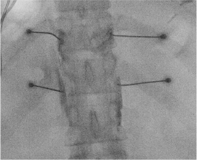 16. Pain in chronic pancreatitis.