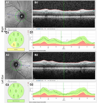 Olfactory Groove Meningioma Compressing the Optic Chiasm and Optic Nerve: Improvement of Visual Functions by Surgical Intervention.