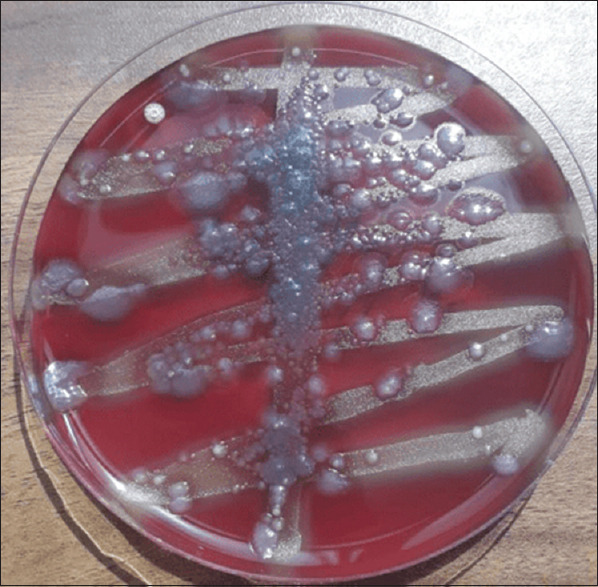 Detection and quantification of <i>Fusobacterium nucleatum</i> and <i>Porphyromonas gingivalis</i> in salivary samples of gutka and non-gutka users- 'A pilot study'.