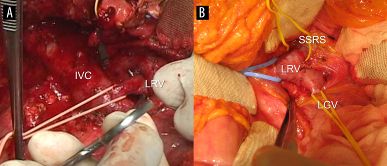 Long-Term Outcomes of Left Renal Vein Ligation in Living Donor Liver Transplantation: A 20-Year Study.