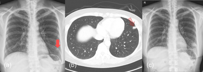 Complete resolution of non-tuberculous mycobacterial pulmonary nodule following cryobiopsy: The first case report.