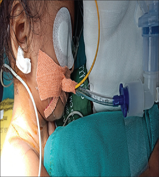 Innovative Use of Pulmonary Artery (PA) Catheter for Lung Isolation in a Pediatric Patient: A Case Report.