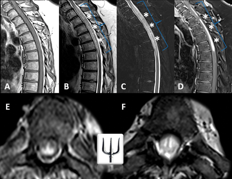 Pointing the trident in the right direction: recognizing spinal neurosarcoidosis through a specific MRI pattern.