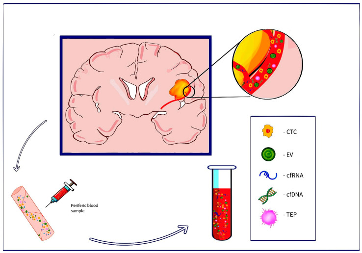 Liquid Biopsy as a Diagnostic and Monitoring Tool in Glioblastoma.