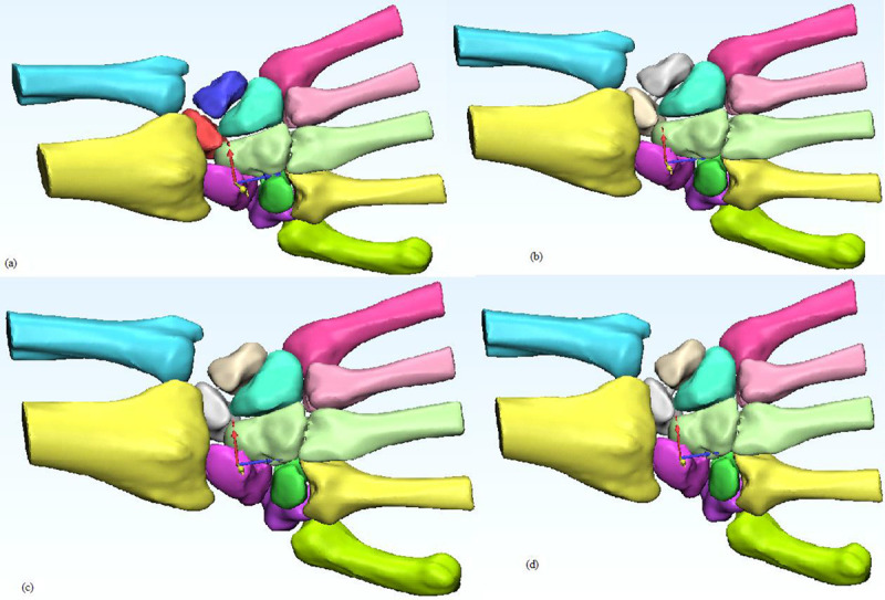 Evaluation of Various Methods of Lunotriquetral Stabilization Surgical Producers, A Finite Element Analysis.