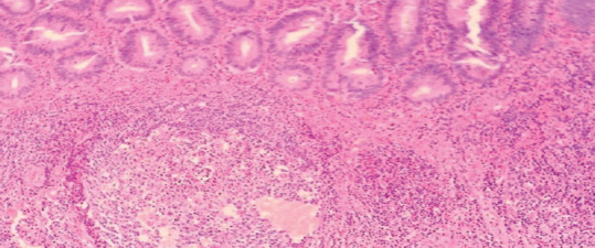 High Diagnostic Accuracy but Persistent Risk of Complicated Appendicitis: A Retrospective Analysis from Hail Province, Saudi Arabia.