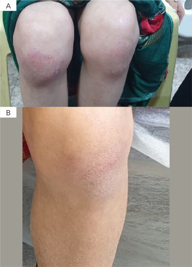 Juvenile Dermatomyositis and Hepatitis B Viral Infection.
