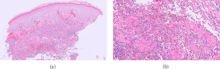 Secukinumab Leading to Rapid Improvement in Pyogenic Arthritis, Acne, Pyoderma Gangrenosum, and Hidradenitis Suppurativa (PAPASH) Syndrome: A Case Report and Review of Treatment Modalities for PAPASH Patients.