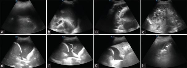 Utilizing thoracic ultrasonography in determining the characteristics of pleural fluid: Development of a novel sonographic scoring system.