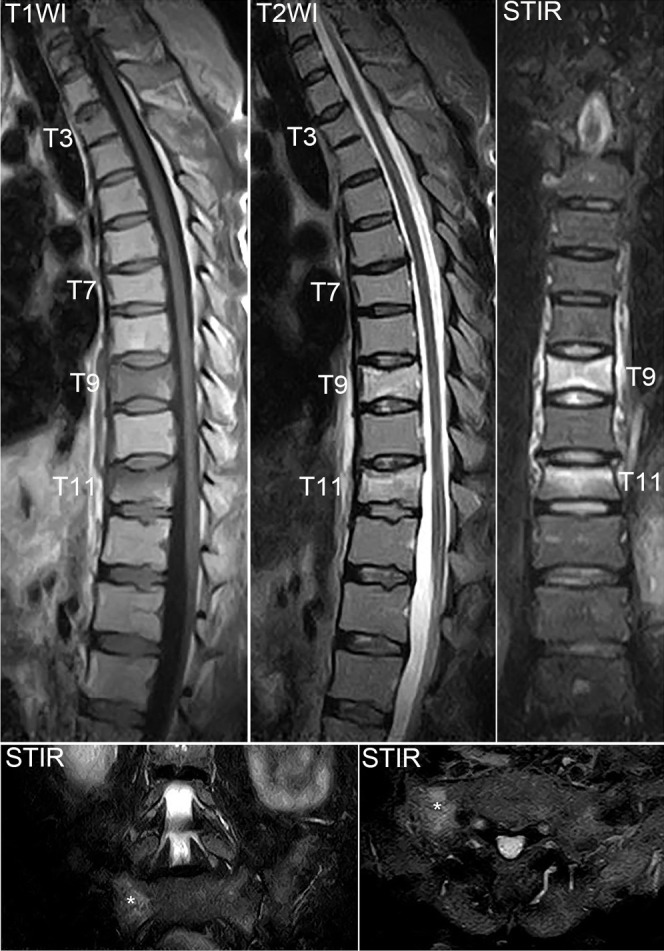 Pregnancy and lactation-related osteoporosis associating multiple vertebral fragility fractures treated with romosozumab: a case report.