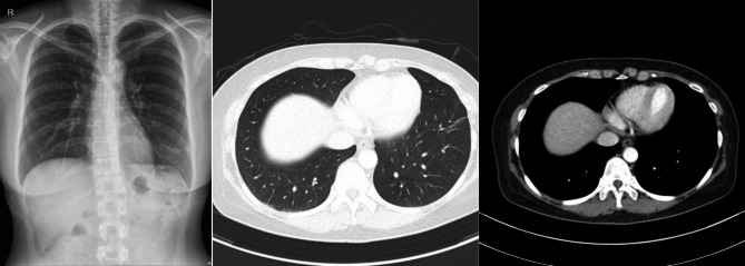 Complete resolution of non-tuberculous mycobacterial pulmonary nodule following cryobiopsy: The first case report.