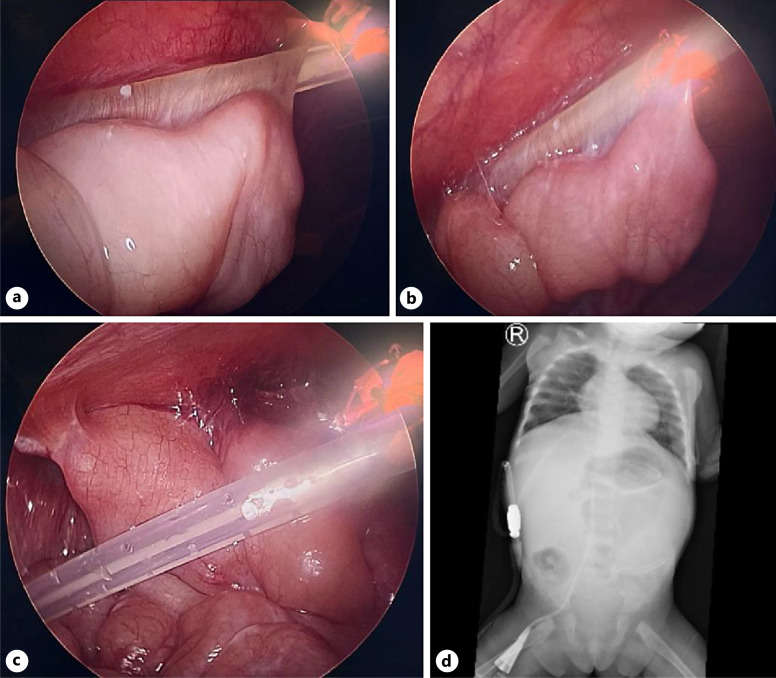 Peritoneal Dialysis Catheter Malfunction due to Adhesion to Ileum: A Case Report.