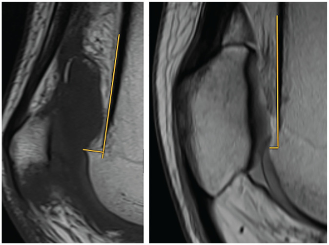 The Effect of a Supratrochlear Spur on Patellofemoral Cartilage in Patients With Trochlear Dysplasia.