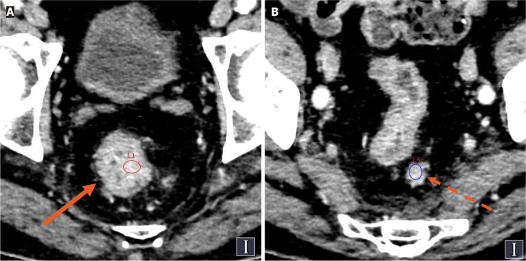 Spectral computed tomography parameters of primary tumors and lymph nodes for predicting tumor deposits in colorectal cancer.