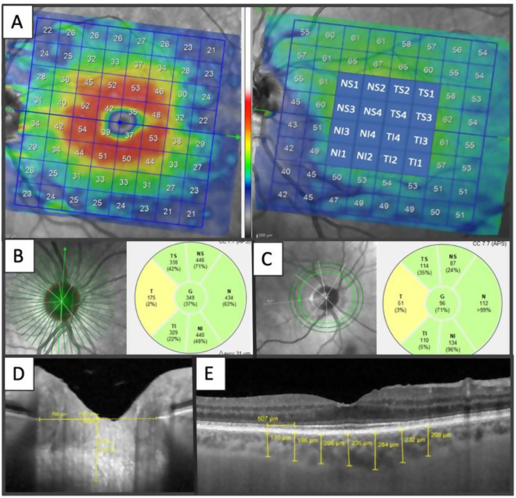 Benefit of continuous positive airway pressure on optic nerve damage in patients with obstructive sleep apnea.