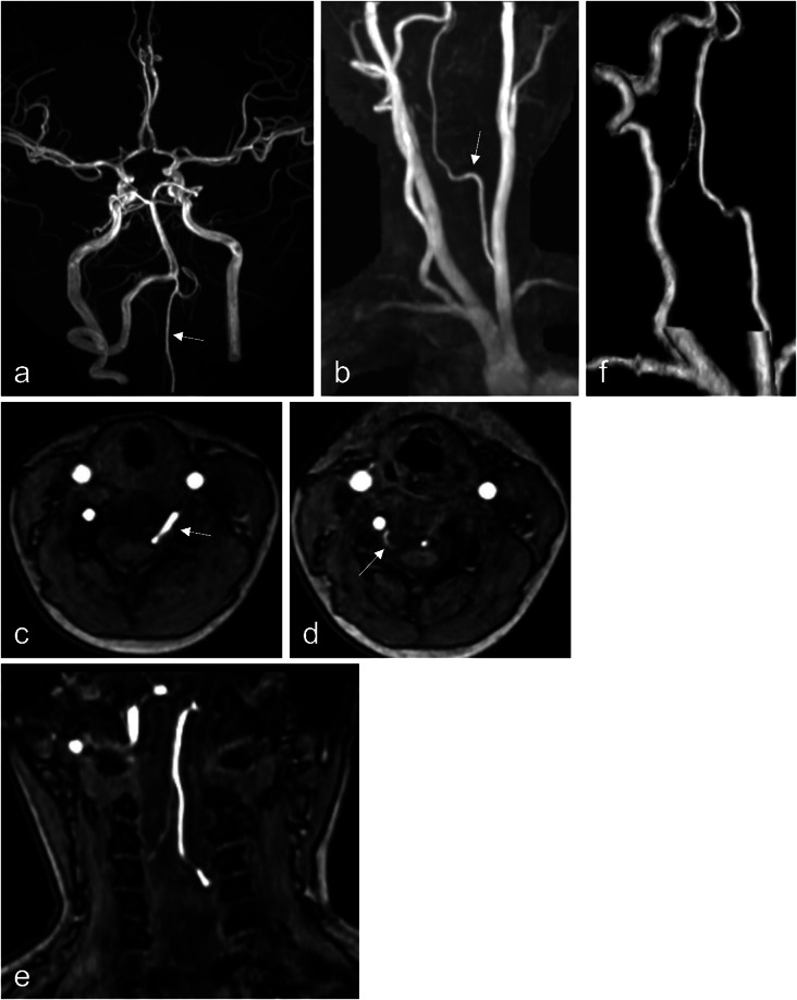 Diagnosis of C5 segmental vertebral artery using magnetic resonance angiography.