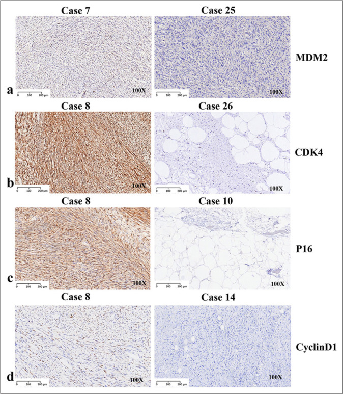 Clinicopathological and molecular diagnostic features of liposarcoma: A study of 27 cases.