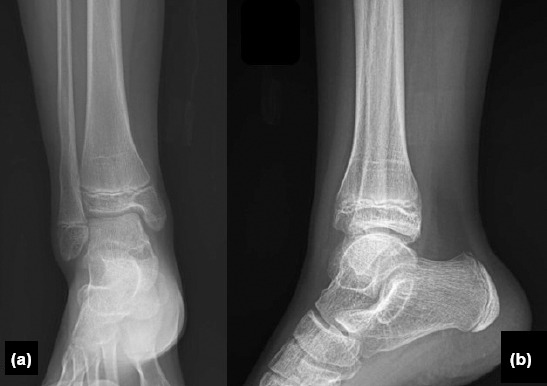 Clinical and radiological outcomes of surgically treated medial malleolus fractures in skeletally immature patients.