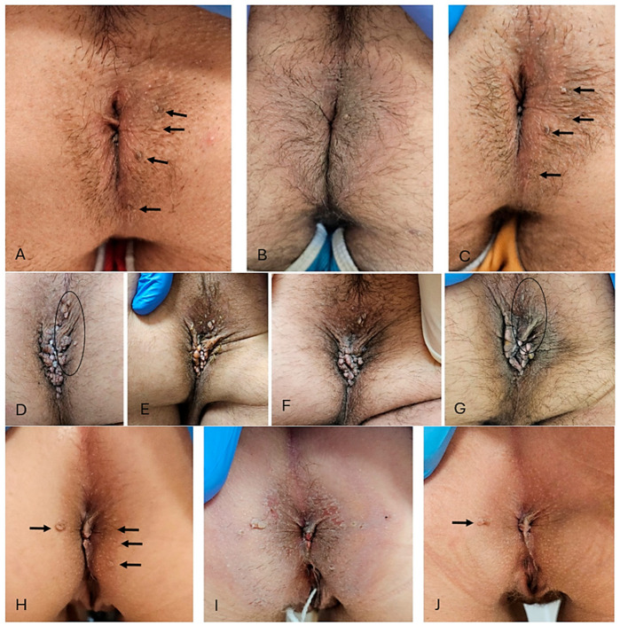 Treatment of Condyloma Acuminata with Tirbanibulin 1% Ointment in People Living with HIV: A Case Series with Literature Review.