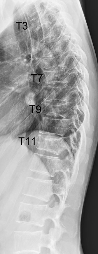 Pregnancy and lactation-related osteoporosis associating multiple vertebral fragility fractures treated with romosozumab: a case report.