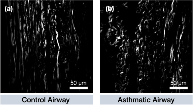 Classification of collagen remodeling in asthma using second-harmonic generation imaging, supervised machine learning and texture-based analysis.