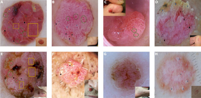 Dermoscopic Features of Eccrine Poromas in Diverse Skin Phototypes: A Retrospective Study of 26 Cases.
