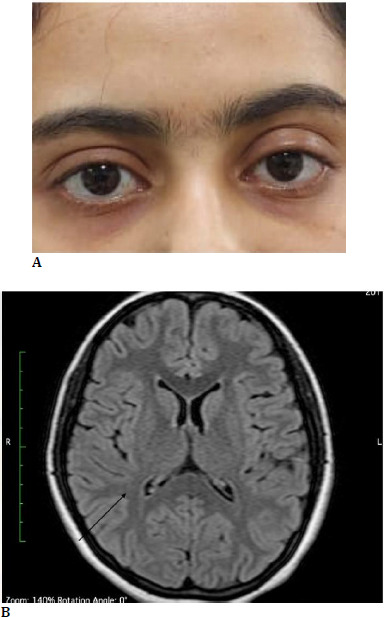 Neurological and neurosurgical conditions presenting first with ophthalmological clinical features: A case series.