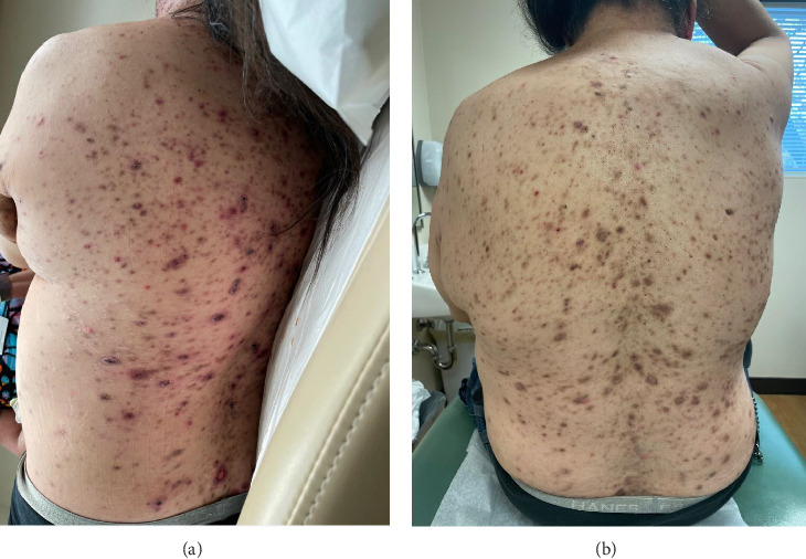 Secukinumab Leading to Rapid Improvement in Pyogenic Arthritis, Acne, Pyoderma Gangrenosum, and Hidradenitis Suppurativa (PAPASH) Syndrome: A Case Report and Review of Treatment Modalities for PAPASH Patients.